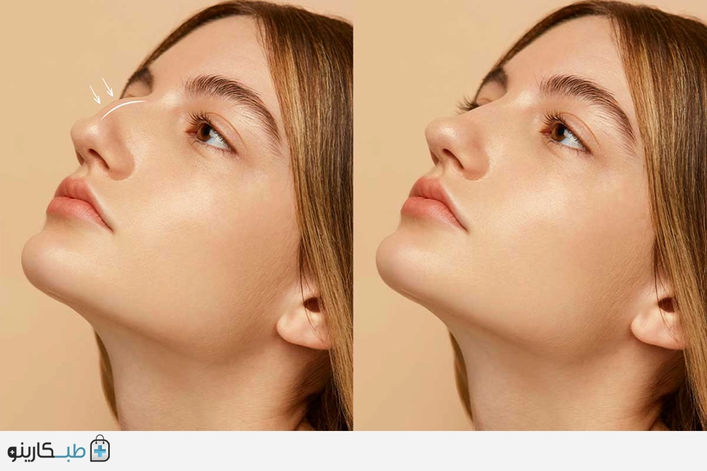 جراحی زیبایی بینی